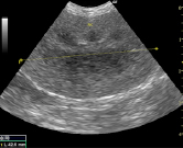 腎臓の超音波検査