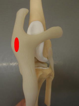 膝蓋骨内方脱臼