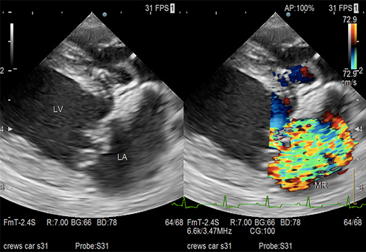 僧帽弁閉鎖不全症（超音波検査）