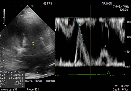 血流速度の測定（ドップラー検査）